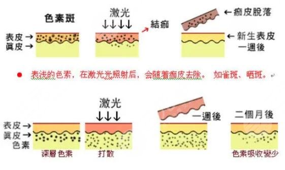 杭州市三医院激光祛痘价格