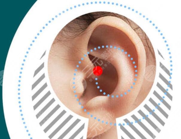 八大处杨庆华小耳畸形整形成好吗?