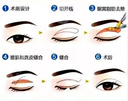 河南省人民医院整形美容科双眼皮手术俞海燕案例