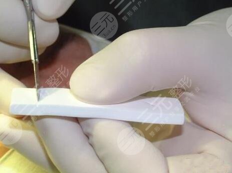 九院整形医院隆鼻整形案例