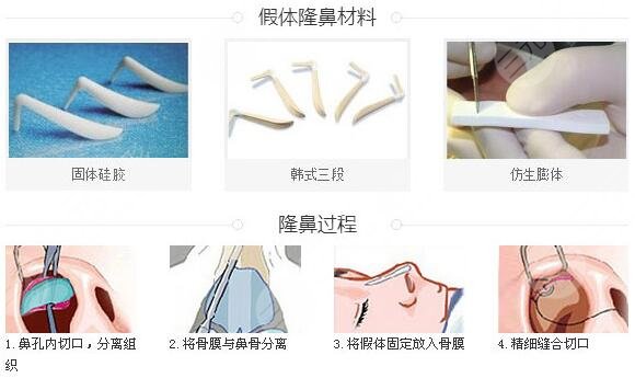 九院整形医院隆鼻整形案例