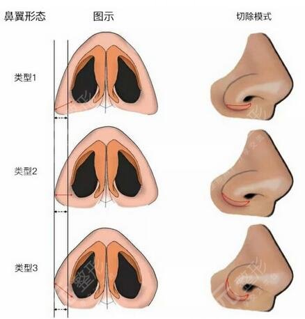 苏北整形美容科2021新版价目表，鼻翼缩小手术案例