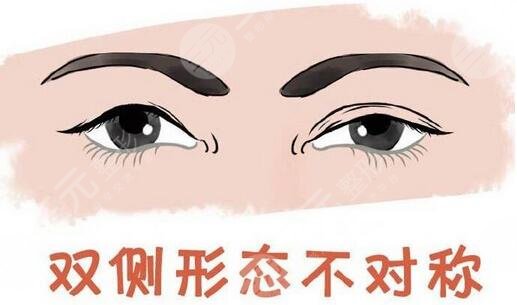 上海九院整形科双眼皮案例