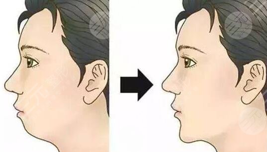 西京整形医院假体垫下巴真实案例分享