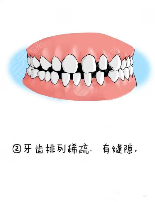 杭州美奥口腔医院洗牙案例分享