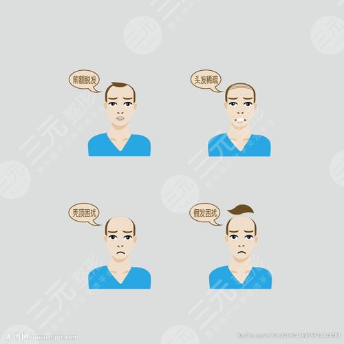 厦门银河秃顶加密植发案例分享