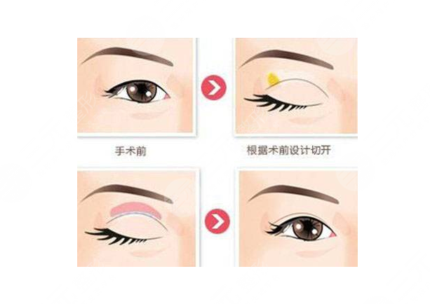 兰大二院整形科价格表2021新版，医生简介|双眼皮修复案例