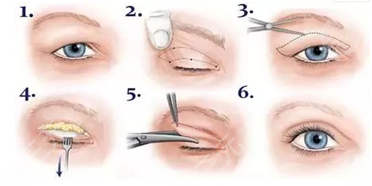 兰大二院整形科价格表2021新版，医生简介|双眼皮修复案例