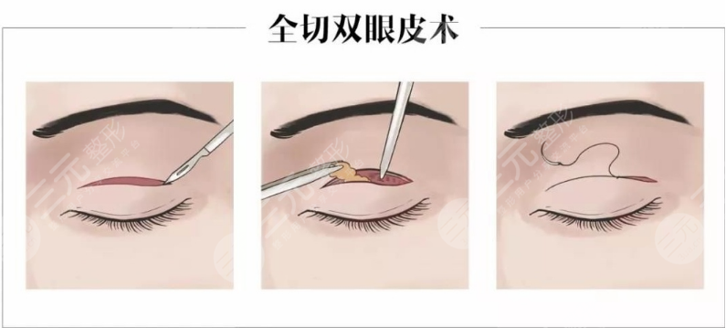 西安西京医院整形美容科割双眼皮前