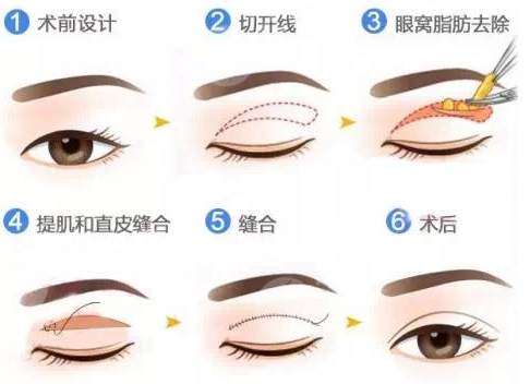 西安西京医院整形美容科割双眼皮后