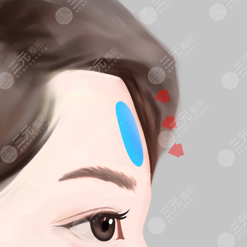 郑楚蓉填充额头案例