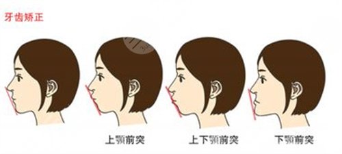 济宁附属医院牙齿矫正前