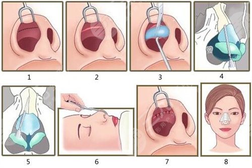李华医生隆鼻前