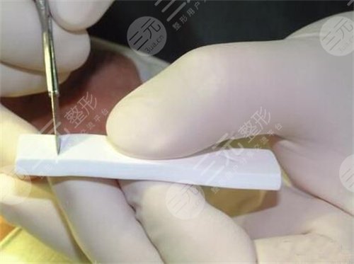 上海九院整形科膨体隆鼻后5天