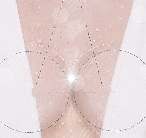 湘雅二医院整形科崭新价目表新鲜出炉啦!附:隆胸案例图+注意事项