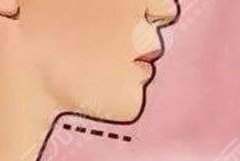 下颌缘吸脂后遗症有哪些，危险大吗？科普带你了解真相！