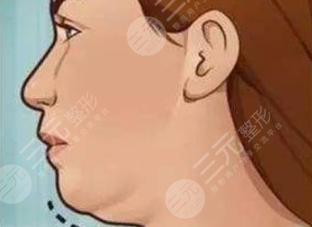 双下巴