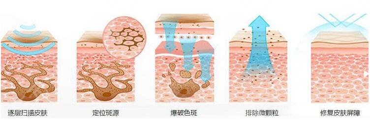 上海九院激光美容激光祛斑案例