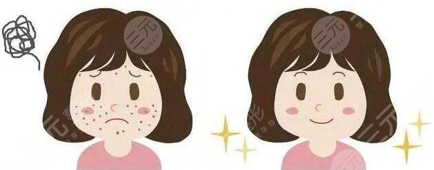 济宁人民医院激光祛痘祛疤图