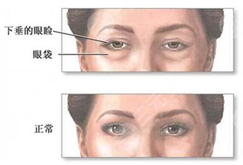 汕头附二整形美容科去眼袋手术