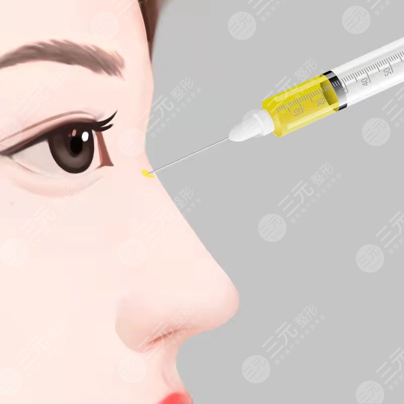 广州曙光整形医院程鹏隆鼻案例前