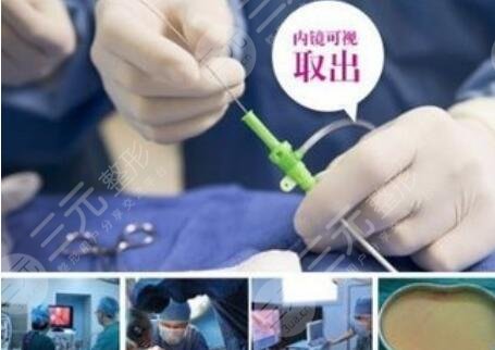 奥美定取出越早越好