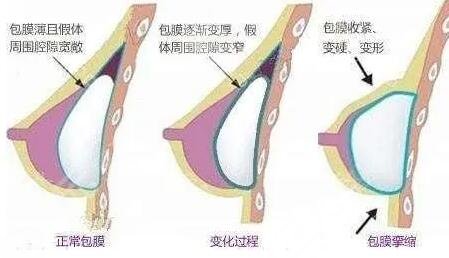毛面假体和光面假体哪个好?