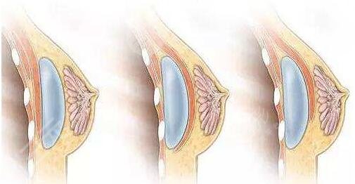 假体隆胸手术术后要注意什么?