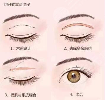 双眼皮手术