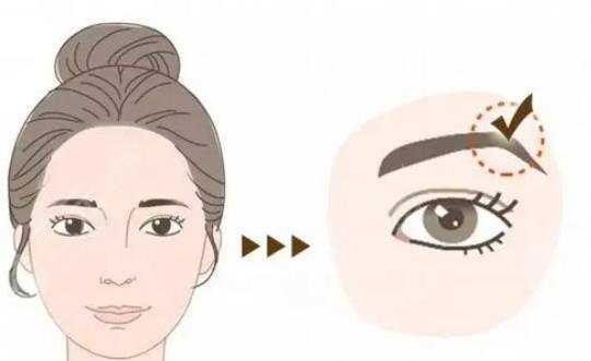 种植眉毛