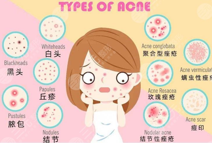 脸皮总长粉刺还去不掉？这8个让你变丑的坏习惯你中了几个！