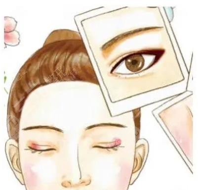 割双眼皮整形术后怎样预防疤痕增长