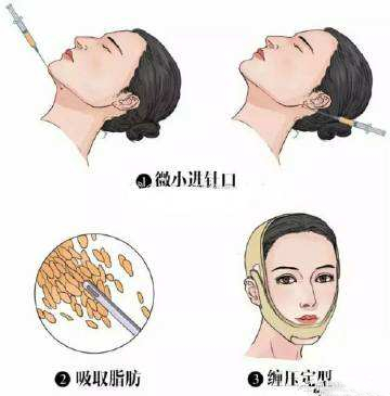 下颌缘吸脂多久才能恢复到自然？理性分析为你解答！面部吸脂功课~