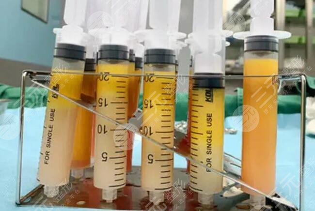 二次冷冻脂肪填充可靠吗？