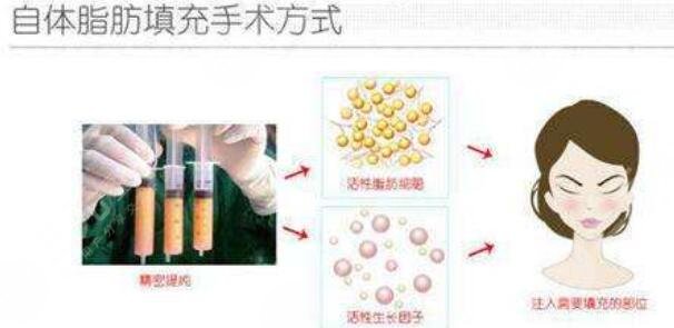 自体脂肪填充面部