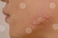 双下巴吸脂疤痕增生怎么办多久能恢复?科普解答&注意事项教你避免! 双下巴吸脂疤痕增生怎么办多久能恢复?科普解答&注意事项教你避免!