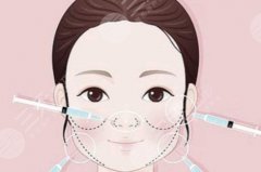 苹果肌脂肪填充可以维持多久？手术优点&原理科普，自然又“减龄”的秘密！