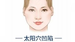 自体脂肪填充太阳凹陷多久恢复?科普分析优点,塑颜小心机! 自体脂肪填充太阳凹陷多久恢复?科普分析优点,塑颜小心机!
