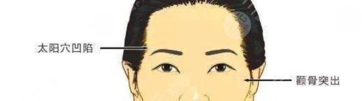 太阳穴凹陷