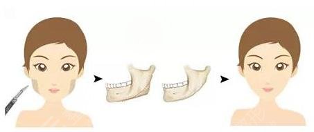 下颌角整容手术