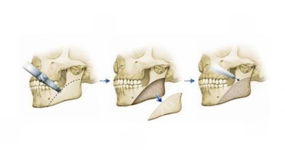 下颌角截骨术果对比图