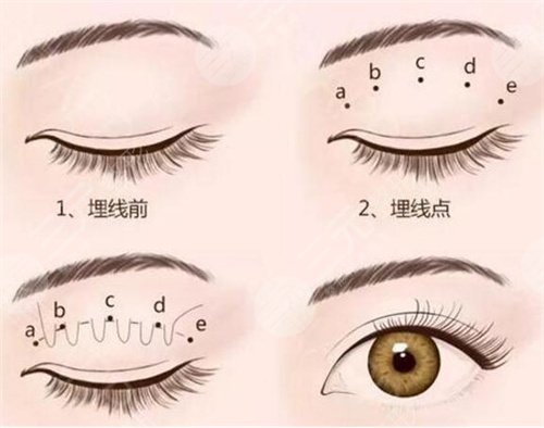 武汉三院张洁双眼皮案例