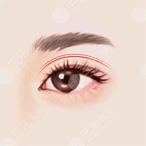 合肥褚燕军双眼皮案例
