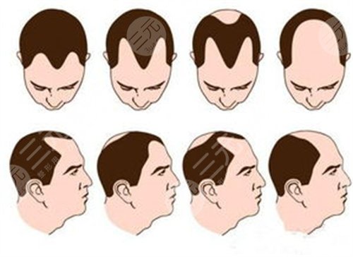 河南省人民医院植发案例