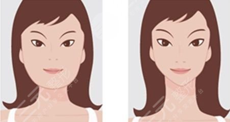 重庆西南医院整形外科隆鼻案例图