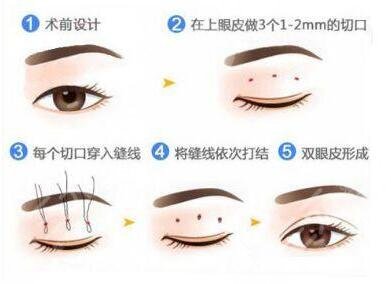 河南省人民医院整形外科双眼皮案例图