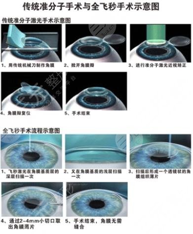 全飞秒近视矫正疼不疼