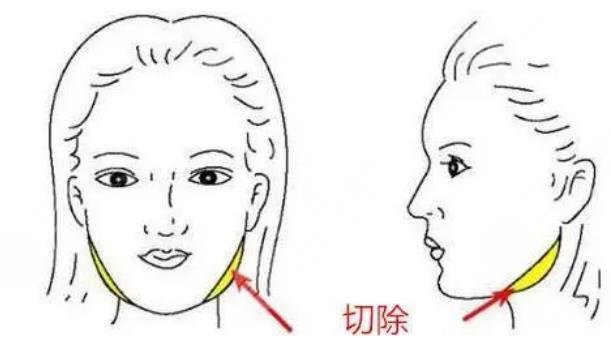 下颌角截骨手术原理