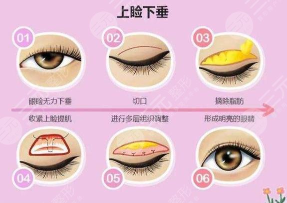 上睑下垂去医院还是整形医院？科普讲解手术原理，了解一下！