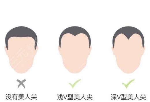 植发美人尖果图分享!多少钱能搞定?2022魅力提升功课! 植发美人尖果图分享!多少钱能搞定?2022魅力提升功课!